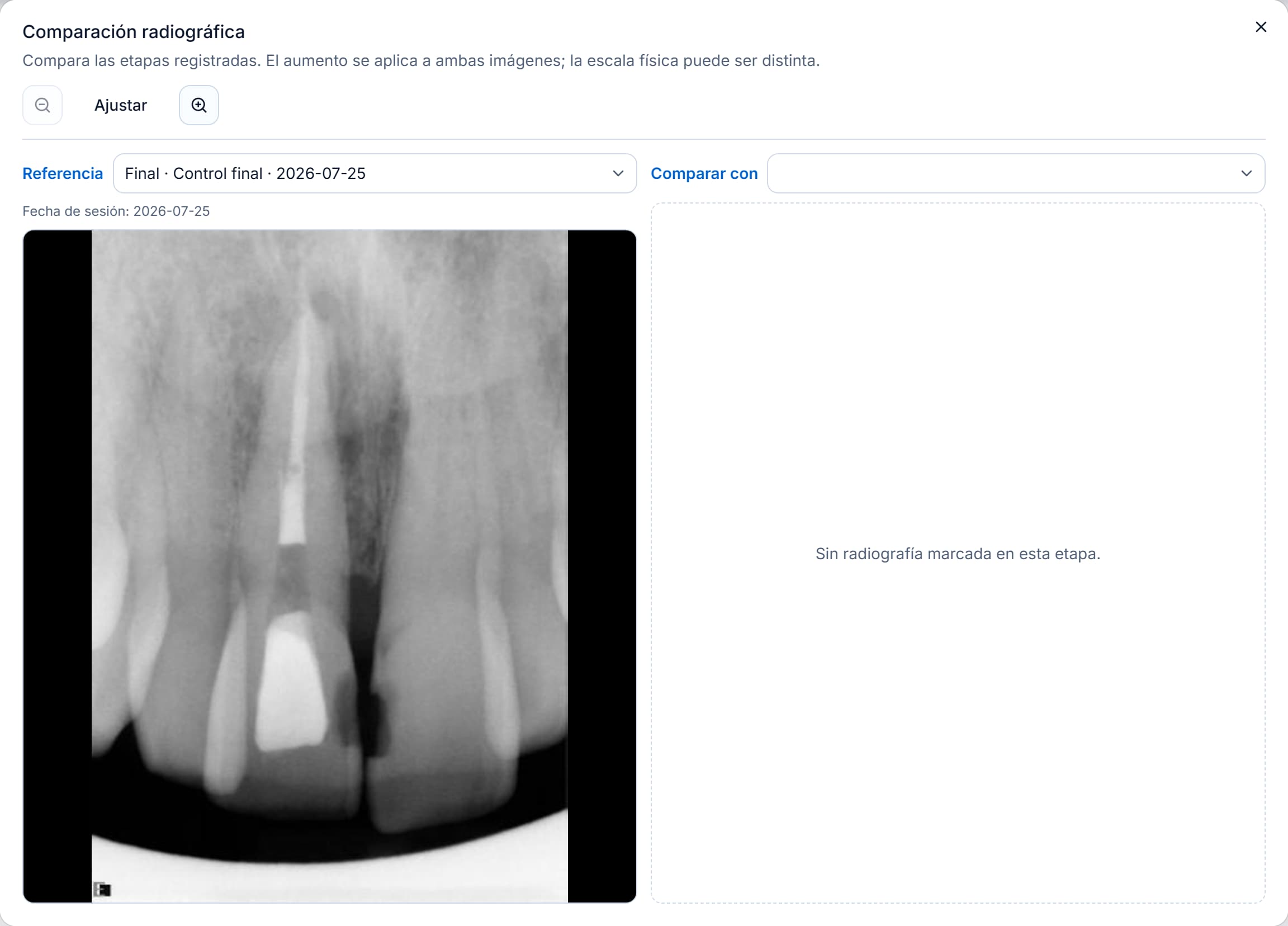 Comparación radiográfica de Endora con la radiografía final y el aviso Sin radiografía marcada en esta etapa.